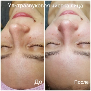 Чистка лица ультразвуком до и после МАСТЕР ИЩЕТ МОДЕЛЬ г.Архангельск ВКонтакте