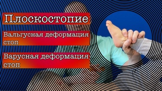 Плоскостопие / Вальгусная, варусная деформация стоп. Фролков С.В.